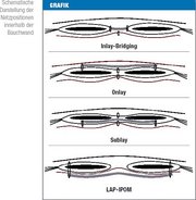 Treatment of incisional hernia